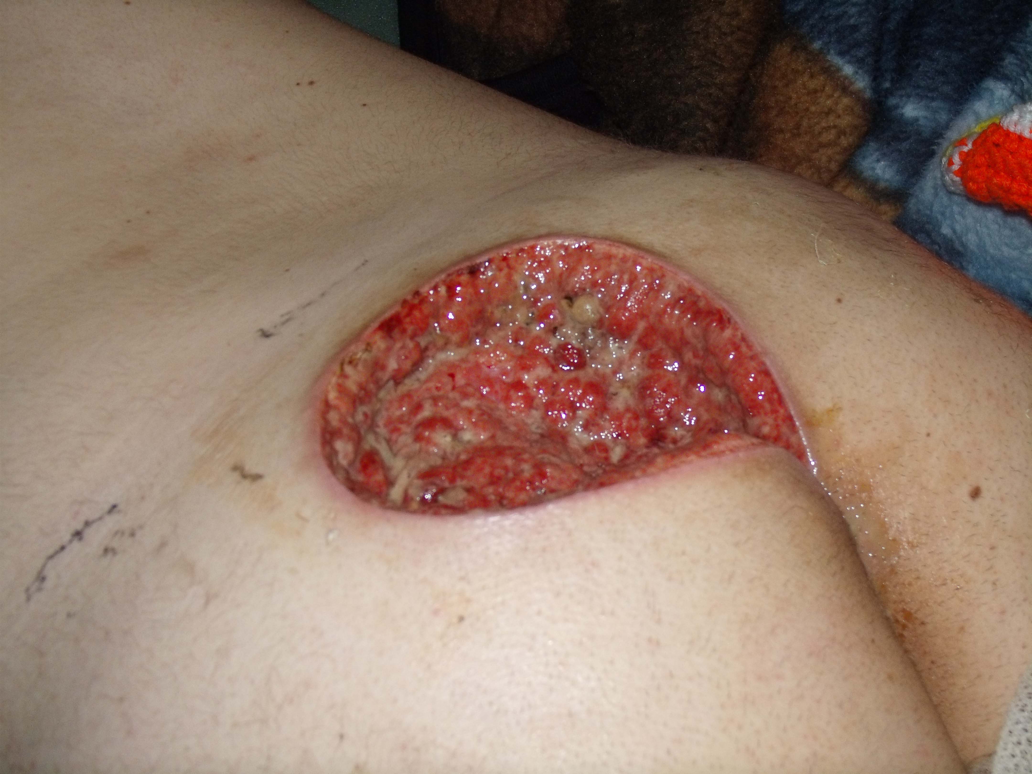 How To Get Rid Of A Pilonidal Cyst, Part Ii